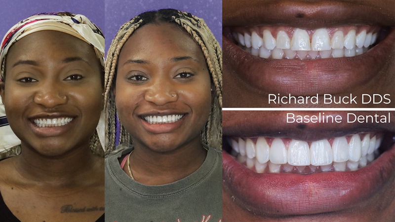 Complete Composite Veneer Tutorial! Cosmetic Resin Dental Makeover with Before & After vs Porcelain