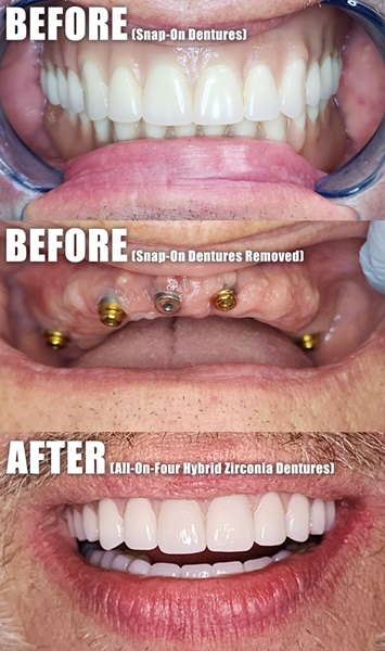 Full Upper Implant Overdenture Before and After