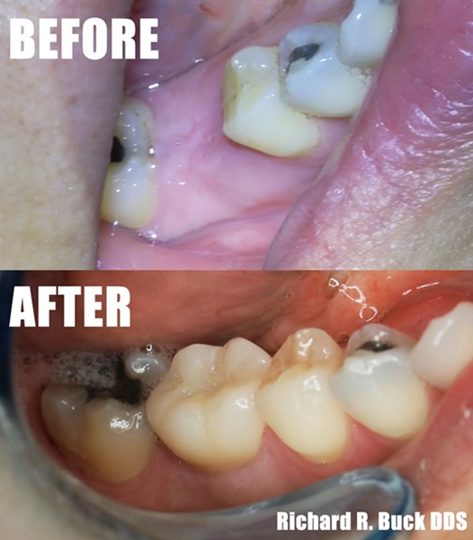 Implant Before and After #30